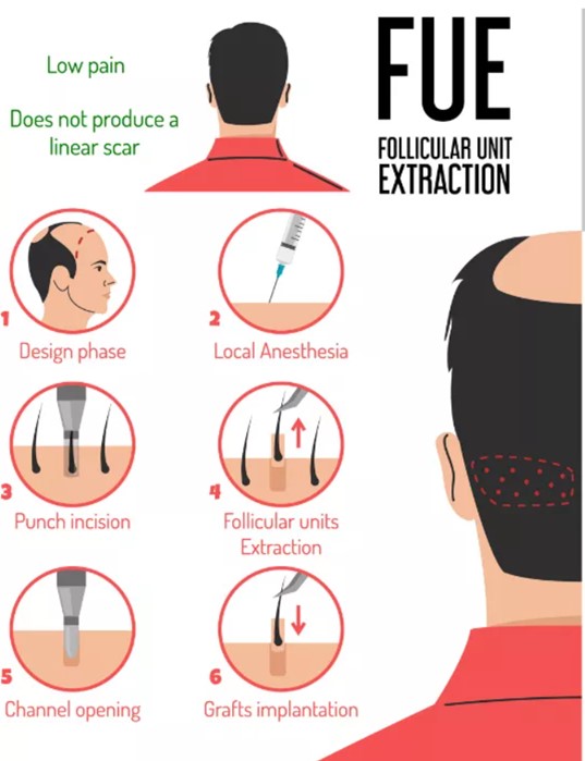 FUE Hair Transplant image Canada1